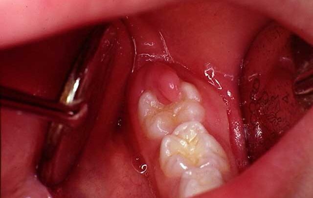 Причини і способи усунення хворобливих відчуттів під час прорізування зуба мудрості