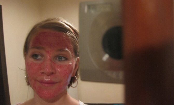 Рекомендації по догляду після лазерної шліфовки Акупалс