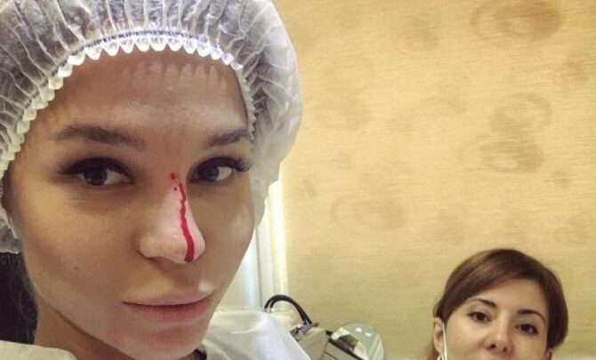 Невдала ринопластика носа: Фото до і після, причини проблем