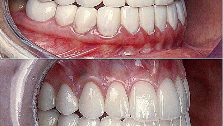 Брекети або вініри – що краще для виправлення прикусу?