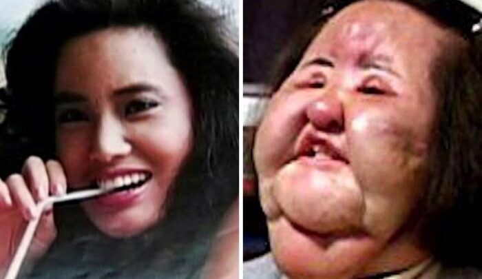 Страшно красиві: найбільш моторошних наслідки пластичних операцій