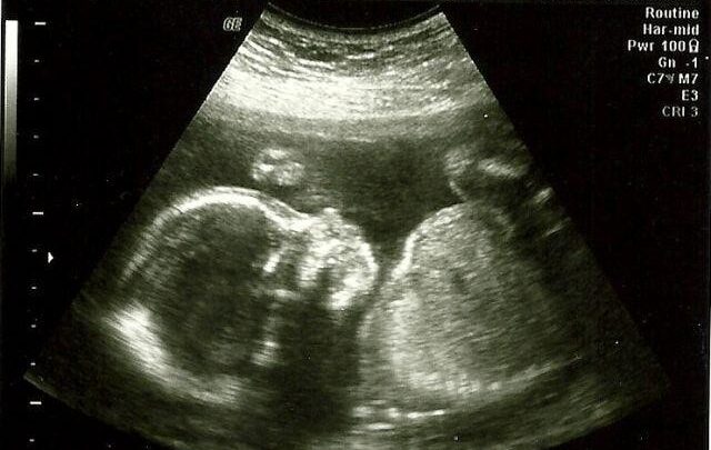 Що відбувається на 29 тижні вагітності і розвиток дитини