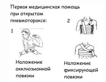 Причини спонтанного пневмотораксу легких – як надати першу допомогу