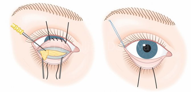 Блефаропластика: показання, види (верхня і нижня), методи операції, відновлення після
