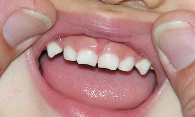 Що таке очні зуби: розташування в порожнині рота і характеристики
