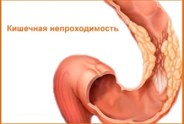 Симптоми дивертикулеза кишечника у дорослих і способи лікування патології