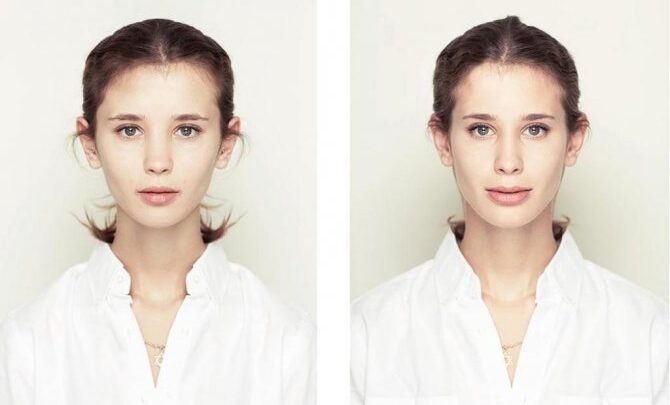 Асиметрія особи: причини, як виправити. Фото хвороби і лікування