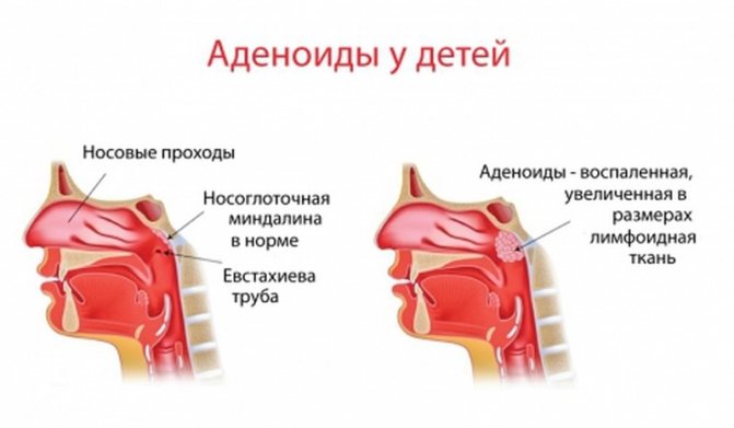 Аденоїди у дітей