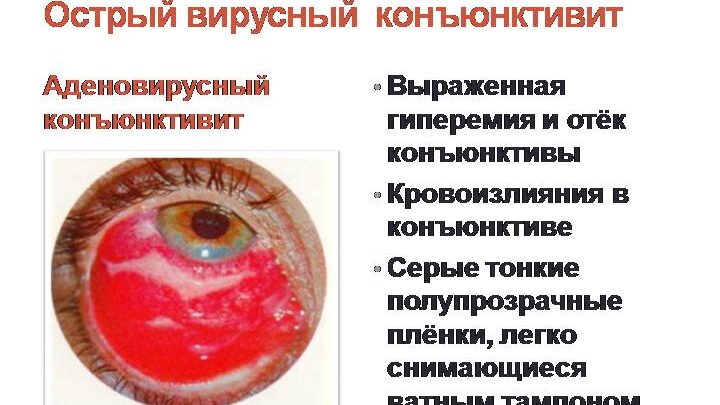 Що таке аденовірусна інфекція у дітей і як її лікувати