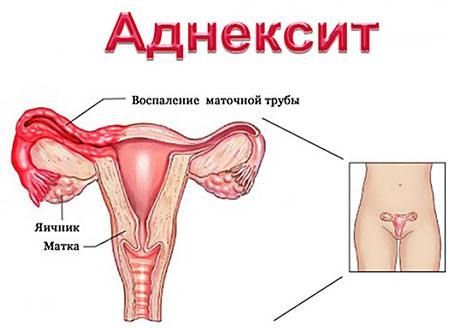 аднексит