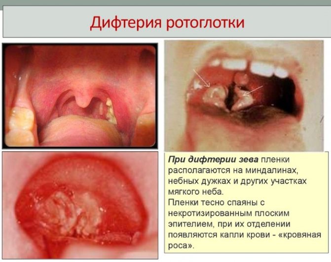 АДСМ щеплення.  Розшифровка дорослим, дітям.  Куди, від чого роблять, графік, наслідки