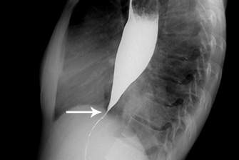 Ахалазії кардії на знімку УЗД