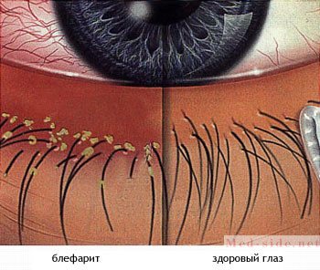 Алгоритми лікування різних видів блефарити з назвами препаратів.  Способи як швидко і назавжди вилікувати блефарит