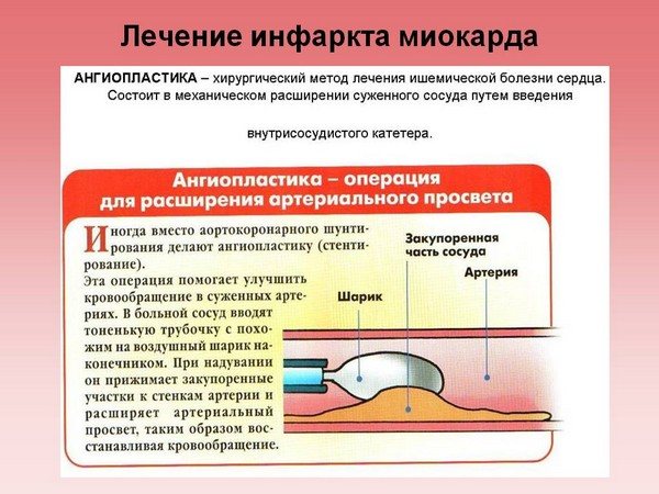 ангіопластика