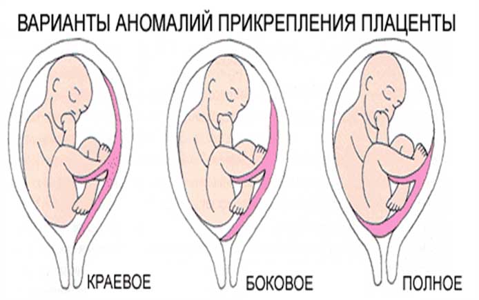 Патологическое прикрепление плаценты предлежание и врастание плаценты. Аномальное расположение плаценты. Аномалии предлежания плаценты. Аномальное прикрепление плаценты. Патология прикрепления плаценты.