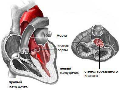 аортальний стеноз