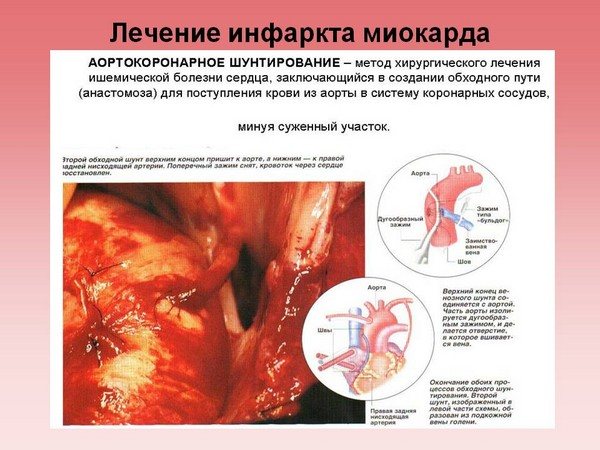 Аортокоронарне шунтування