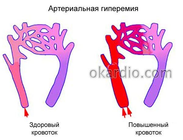 артеріальна гіперемія