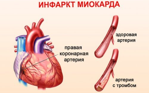 Артерії при інфаркті