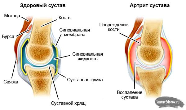 Артрит колінного суглоба: симптоми і лікування, причини хвороби