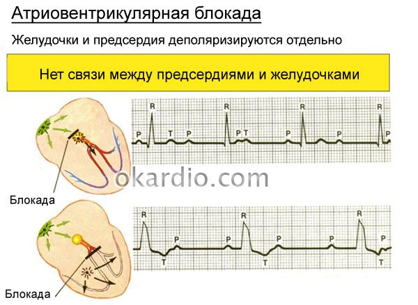 атріовентрикулярнаблокада