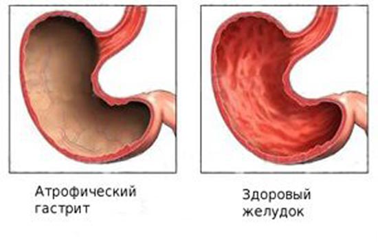 атрофічний гастрит