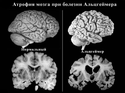 Хвороба Альцгеймера – що це, симптоми і ознаки, причини виникнення, лікування, стадії