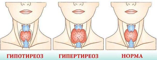 Кіста щитовидної залози: що це таке, як лікувати захворювання, можливі ризики і ускладнення