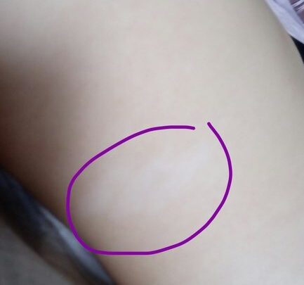 Видалення родимок на обличчі лазером. Наслідки після видалення родимок на обличчі, фото, відгуки