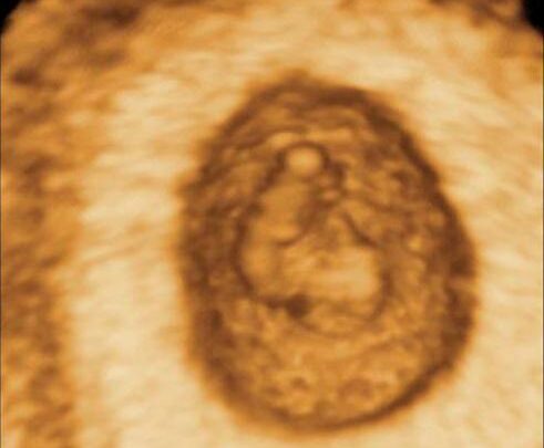 Вагітність 6 тижнів – розвиток плода і відчуття жінки