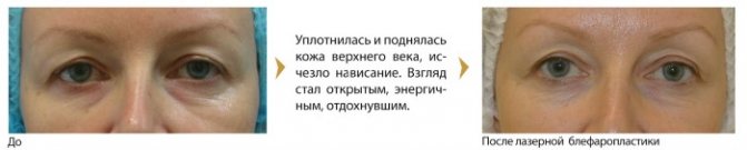 Безопераційна блефаропластика верхніх і нижніх повік: кругова, лазерна, апаратна.  Ціни, реабілітація та можливі ускладнення