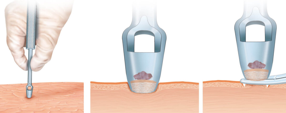 Как происходит процедура биопсии кожи