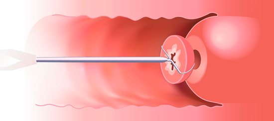 біопсія при дисплазії шийки матки