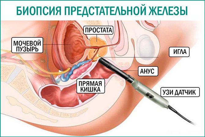 біопсія простати