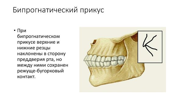 Біпрогнатіческій прикус фото