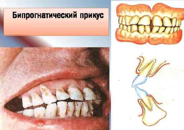 Види правильних і патологічних прикусів з описами і фото