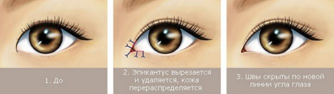 Основні ознаки ектропіону століття і методи усунення проблеми