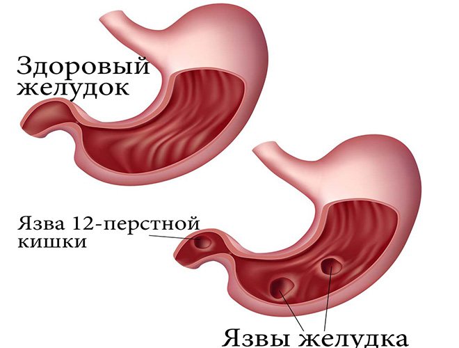 Біль, печіння і важкість у області сонячного сплетіння