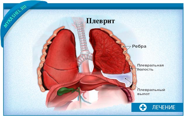 Формы плеврита