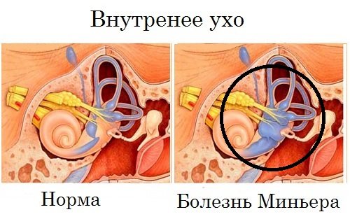 Клінічна картина хвороби Меньєра, як впоратися з недугою