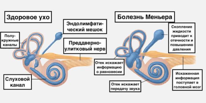 хвороба Меньєра