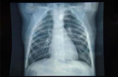 Бронхіт на рентгені легень