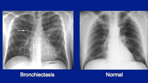 Бронхоектази на рентгені