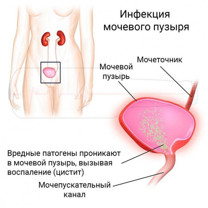 Бруснівер при вагітності при циститі