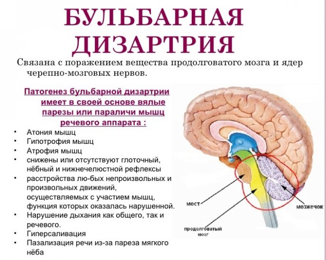 бульбарна дизартрія в зображенні