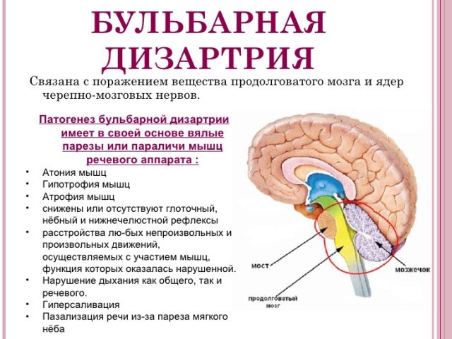 бульбарная дизартрія