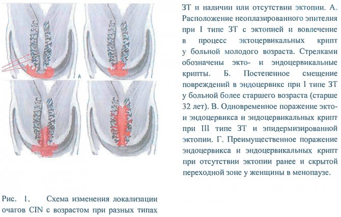 Цервікальна інтраепітеліальна неоплазия шийки матки