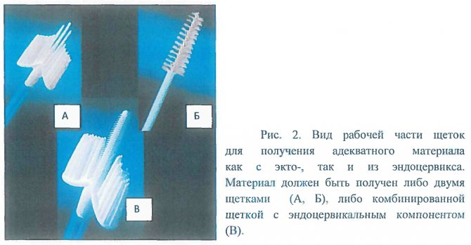 Цервікальна інтраепітеліальна неоплазия шийки матки