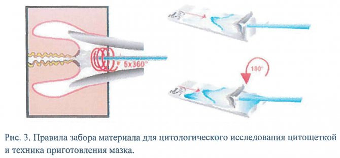 Які можуть бути симптоми дисплазії шийки матки: як діагностувати захворювання і можливі методи лікування