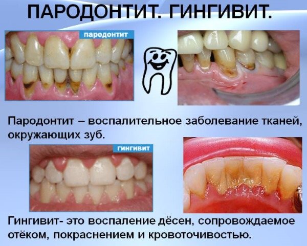 Чим лікувати запалення ясен, причини.  Мазі, антибіотики, полоскання, таблетки, гель, трави